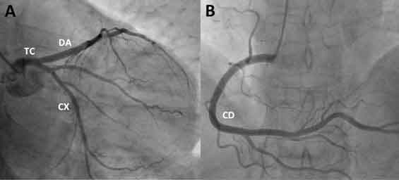 Figura 13. Coronariografía.