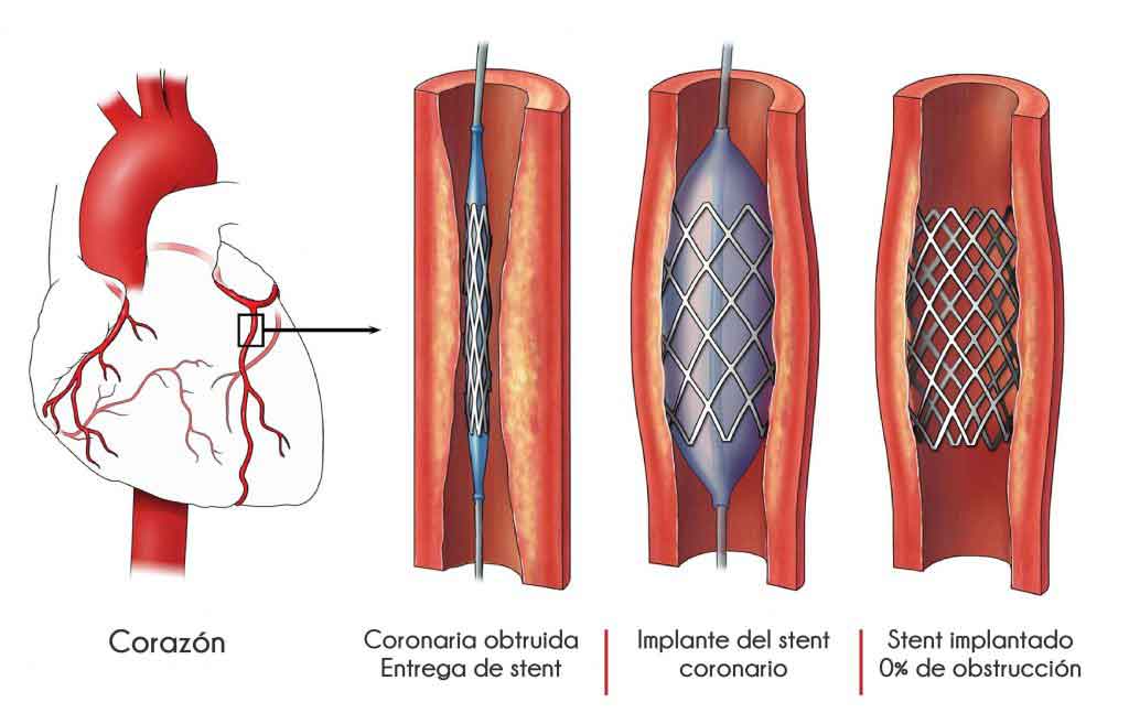 Figura 16. Esquema que indica los pasos para implantación de un estent.