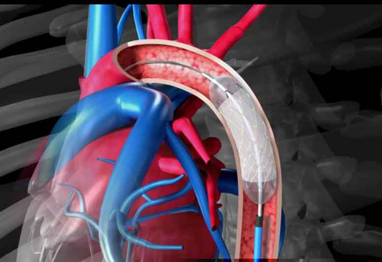 Figura 17. Mediante un globo hinchado se aplasta la placa de ateroma.