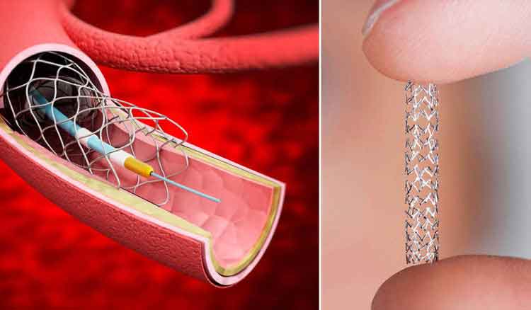 Figura 18. Implantación de un dispositivo estent.