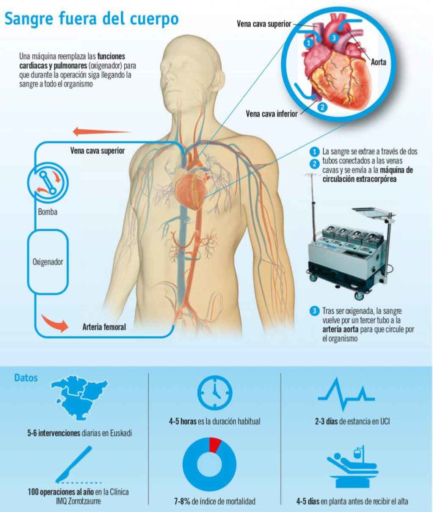 Figura 20. Mediante la circulación extracorpórea se puede detener la actividad eléctrica del corazón para efectuar la técnica de revascularización coronaria.