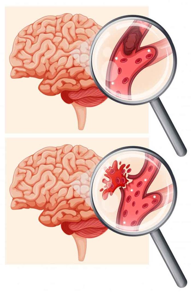 Fig. 1. Dos tipos de infarto cerebral: isquémico parte superior y hemorrágico. Fig. 1. Dos tipos de infarto cerebral: isquémico parte superior y hemorrágico.