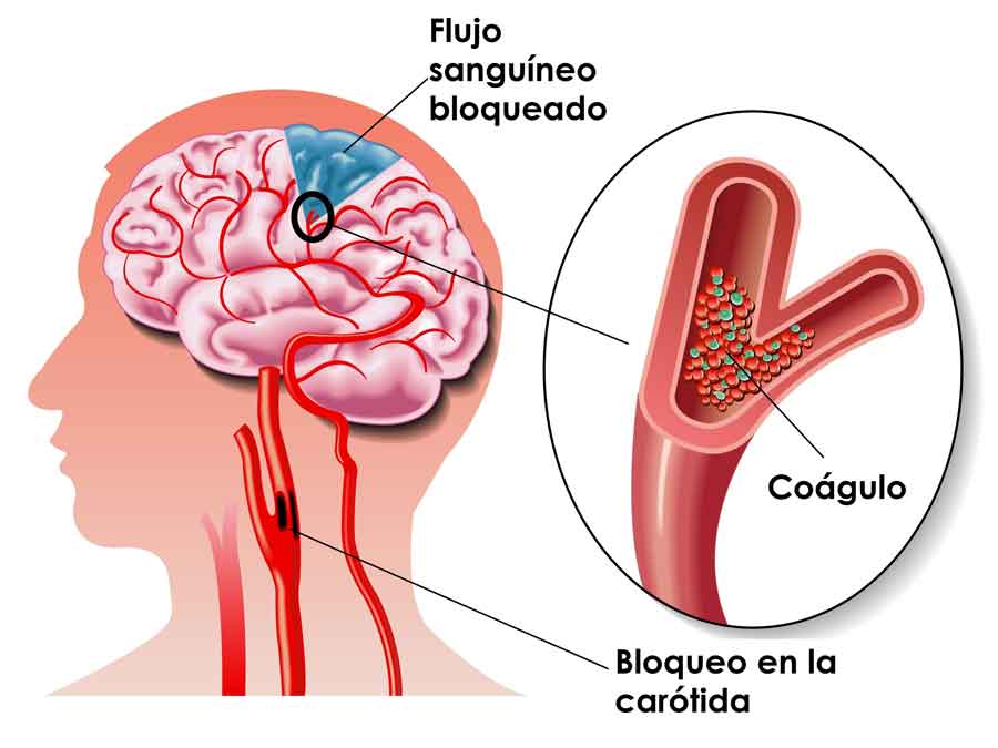 Figura 4. Embolia cerebral.