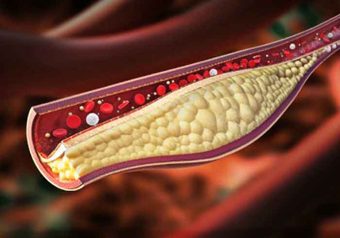 Figura 1. Arteriosclerosis. Deposito de grasa en las arterias.