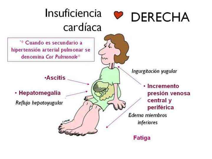 Figura 2. Insuficiencia cardíaca derecha