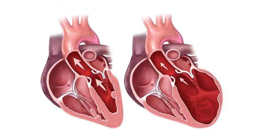 Figura 3. Corazón normal y miocardiopatía dilatada.