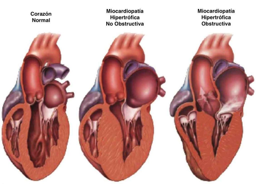 Figura 4. Corazón normal y miocardiopatía hipertrófica.