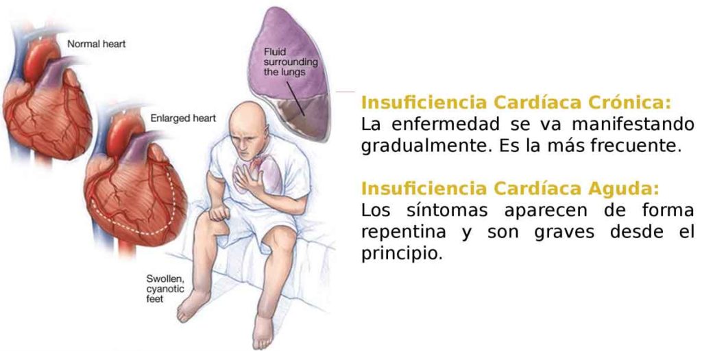 Figura 5. Síntomas de insuficiencia cardiaca según la forma de presentación.