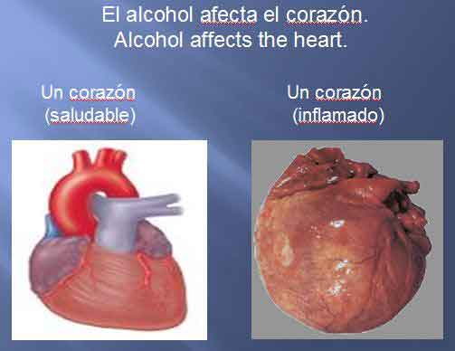 Figura 1. El consumo de alcohol puede llevar a insuficiencia cardiaca.